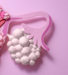 תסמונת שחלה פוליציסטית - תמונת המחשה